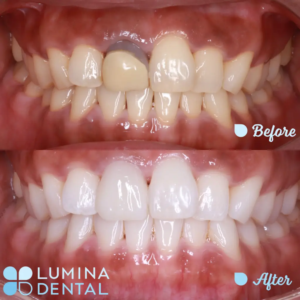 Special Whitening - Internal Bleaching, New Veneer and Full Teeth Whitening