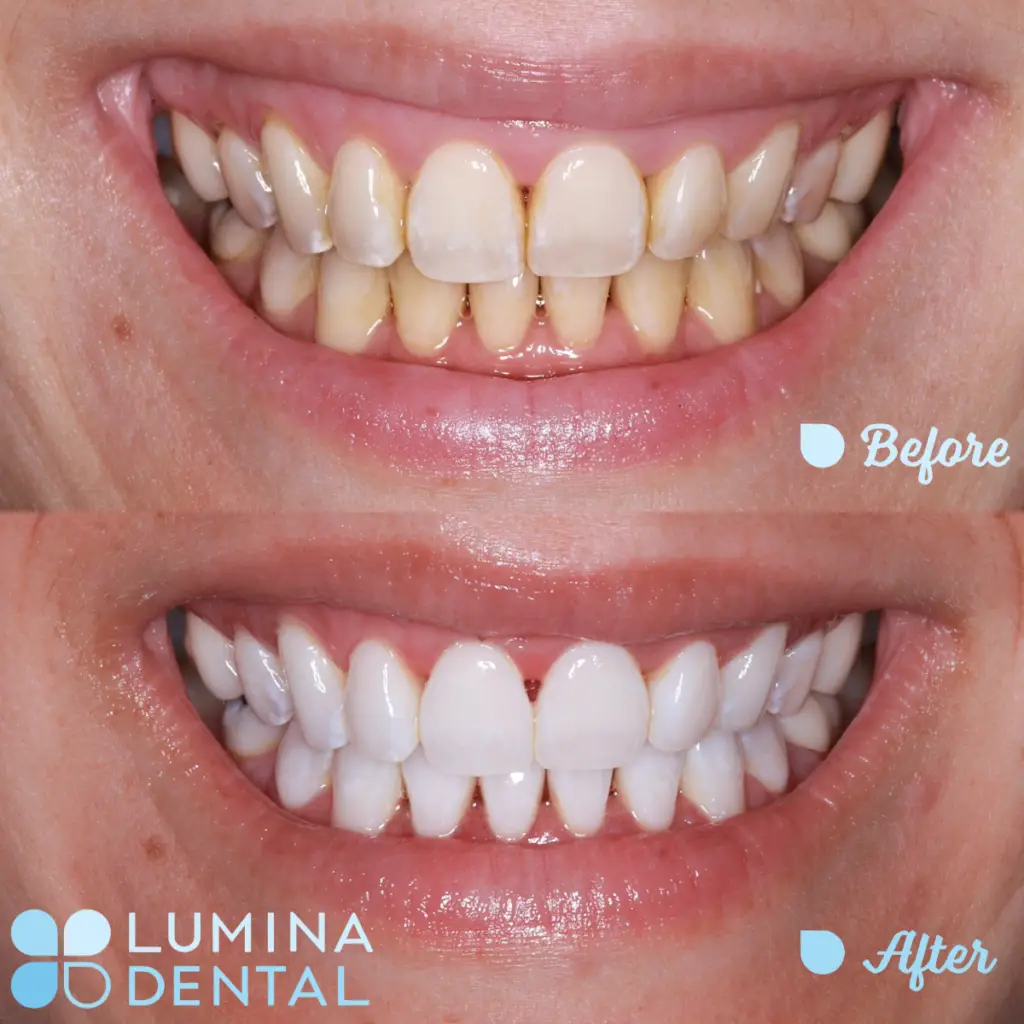 Special Whitening - Much Whiter And Brighter Smile