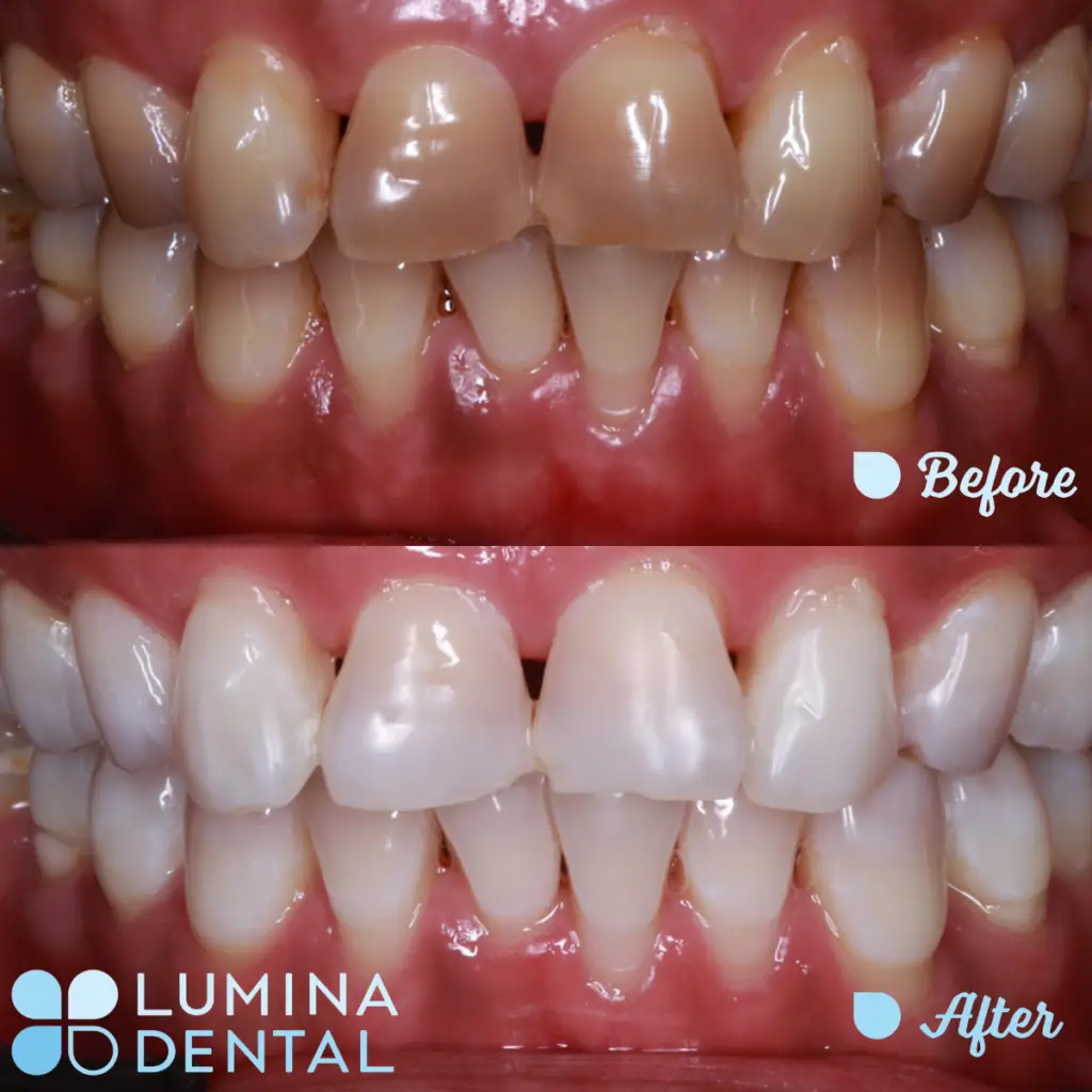 Special Whitening - Removing Strong Discolouration Caused By Antibiotics