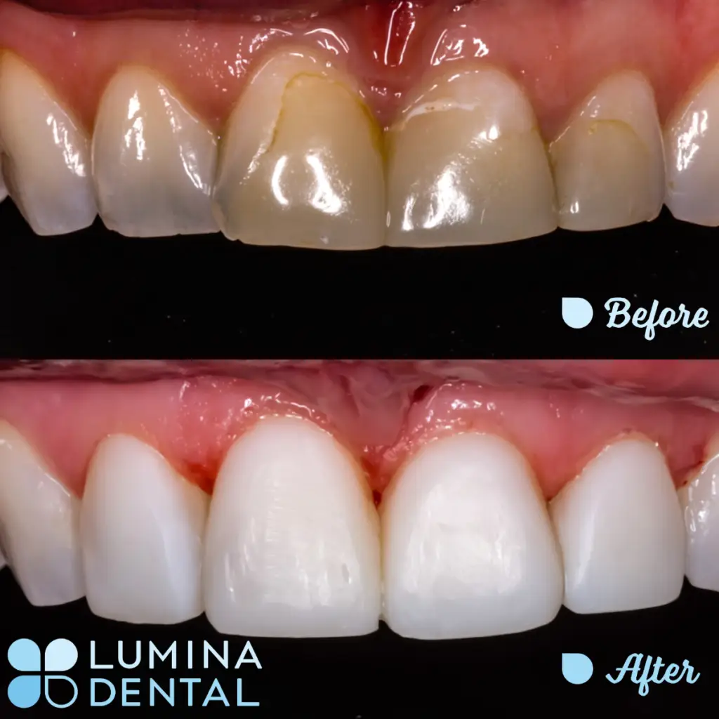 Lumina Veneer - Adjusting and Perfecting the Colour & Shape