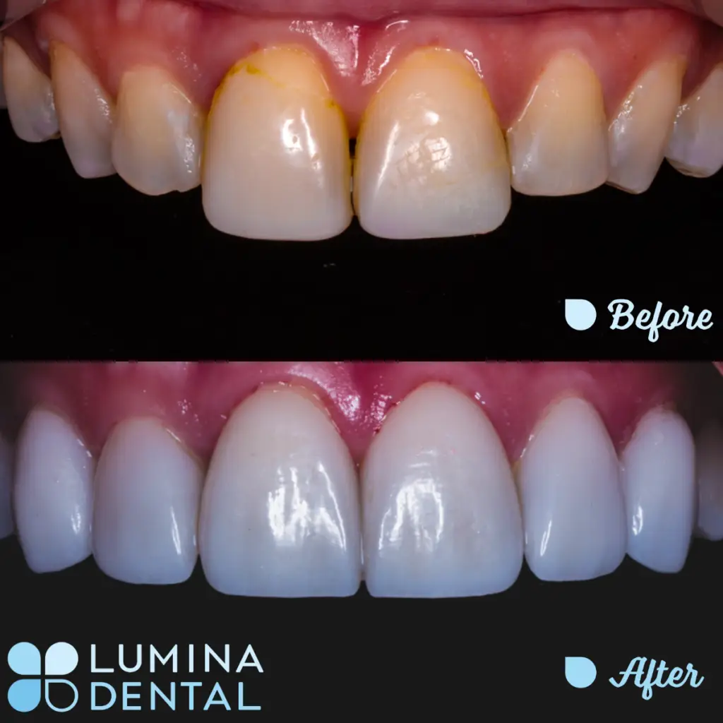 Lumina Veneer - Masking the Size and Shape of Original Teeth While Showing Clarity
