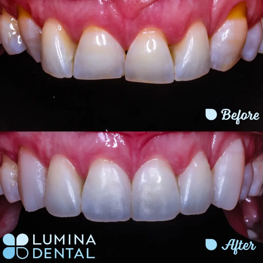 Lumina Veneer - Replacing Previously Failed Veneers While Correcting the Shapes